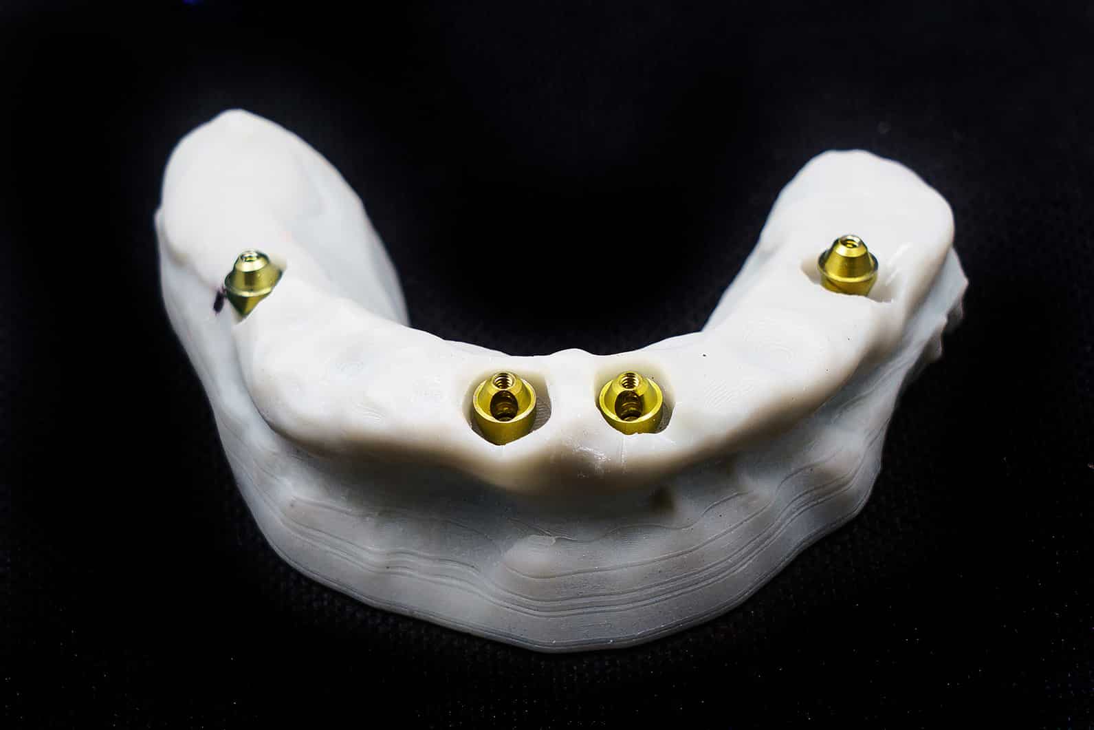 multi-tooth implants at Smiles Only