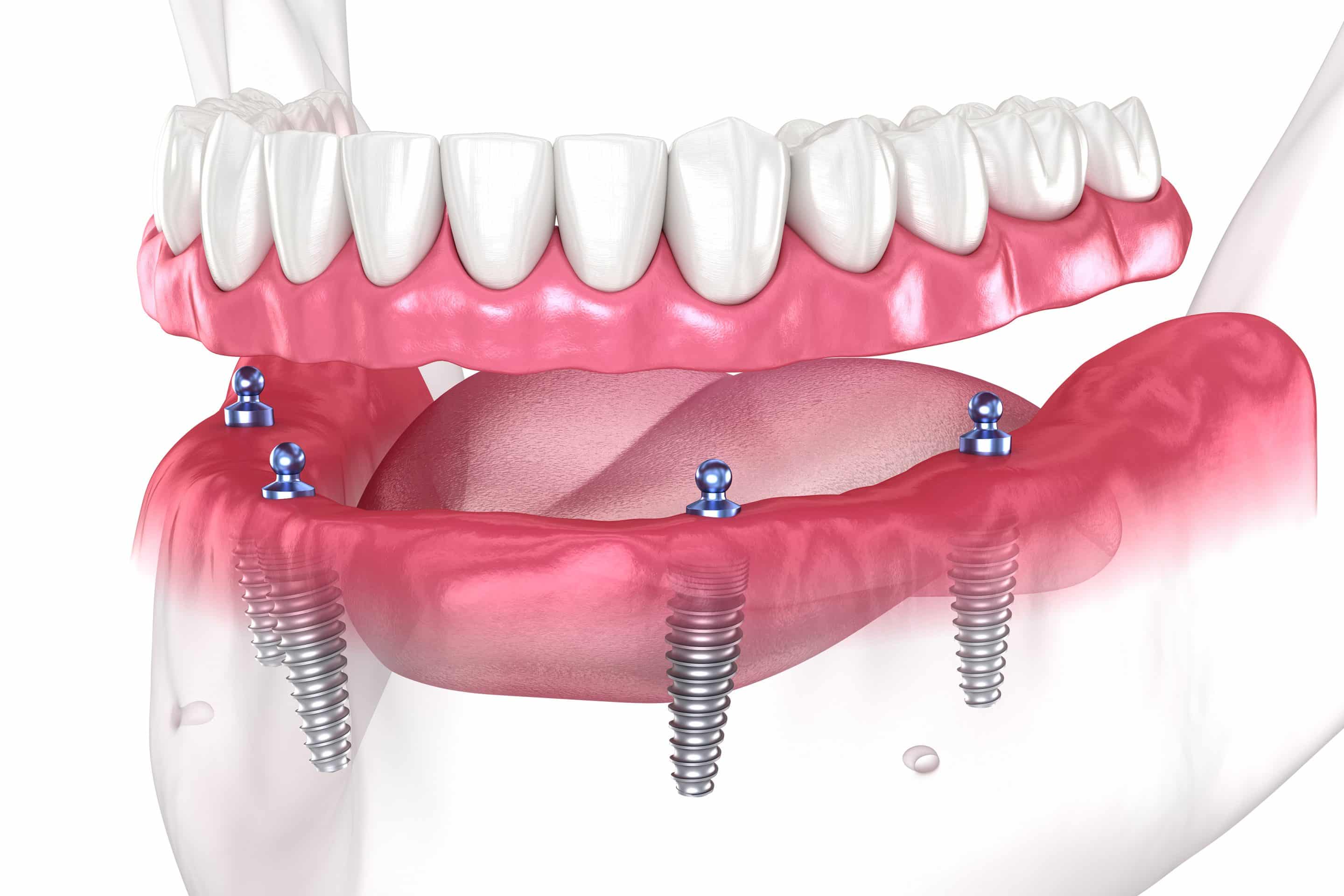 all-on-4 implants at Smiles Only